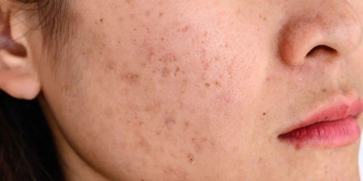 Acne Melasma Treatment in Baner