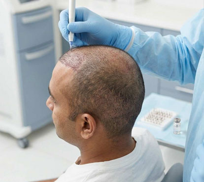 Hair Transplant Treatment Benefits
