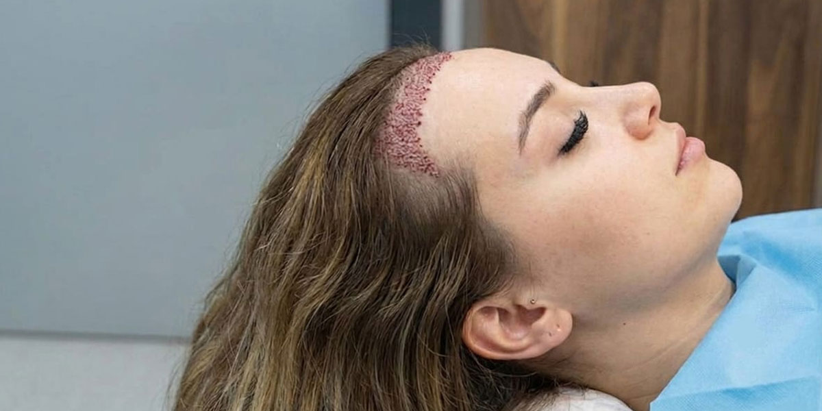 Hair Transplant Treatment in Baner