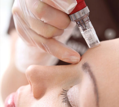Microneedling Treatment Benefits