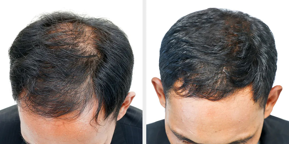 QR678 Treatment in Baner