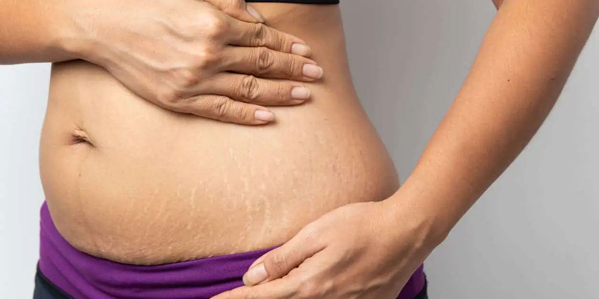 Scar & Stretch Marks Treatment in Baner