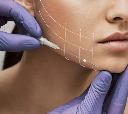 Threads Lift Facial Treatment
