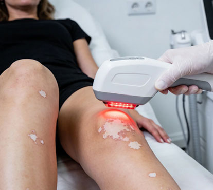 Vitiligo Skin Treatment